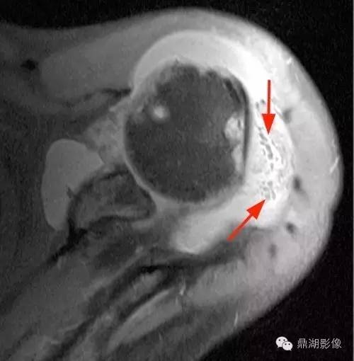 【病例】类风湿关节炎1例MRI诊断分析 【病例】类风湿关节炎1例MRI诊断分析