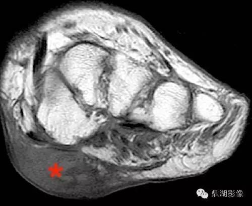 【病例】类风湿关节炎1例MRI诊断分析 【病例】类风湿关节炎1例MRI诊断分析
