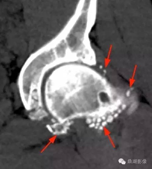 【病例】类风湿关节炎1例MRI诊断分析 【病例】类风湿关节炎1例MRI诊断分析