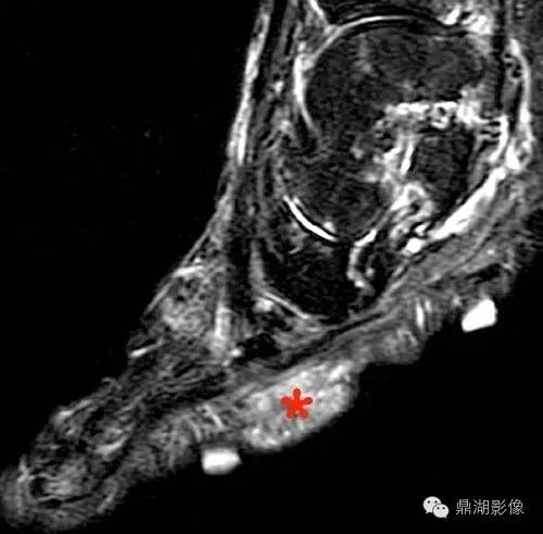【病例】类风湿关节炎1例MRI诊断分析 【病例】类风湿关节炎1例MRI诊断分析