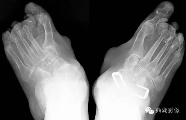 【病例】类风湿关节炎1例MRI诊断分析 【病例】类风湿关节炎1例MRI诊断分析
