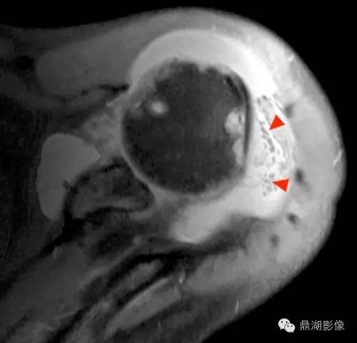 【病例】类风湿关节炎1例MRI诊断分析 【病例】类风湿关节炎1例MRI诊断分析