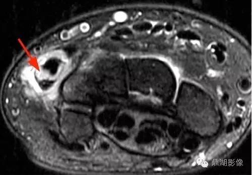 【病例】类风湿关节炎1例MRI诊断分析 【病例】类风湿关节炎1例MRI诊断分析