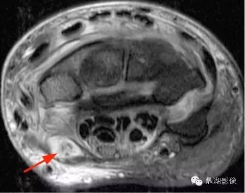 【病例】类风湿关节炎1例MRI诊断分析 【病例】类风湿关节炎1例MRI诊断分析