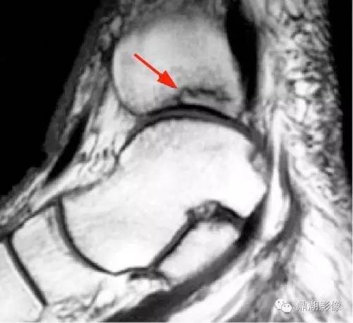 【病例】类风湿关节炎1例MRI诊断分析 【病例】类风湿关节炎1例MRI诊断分析