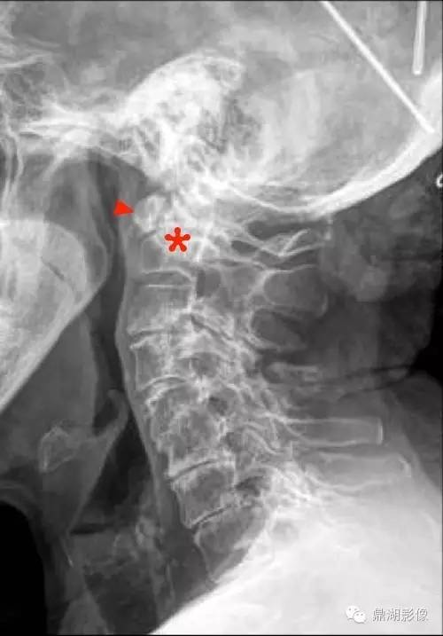 【病例】类风湿关节炎1例MRI诊断分析 【病例】类风湿关节炎1例MRI诊断分析