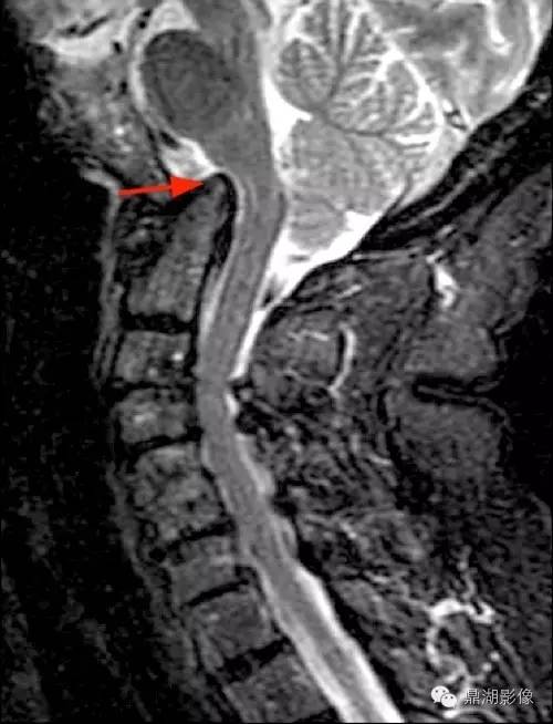 【病例】类风湿关节炎1例MRI诊断分析 【病例】类风湿关节炎1例MRI诊断分析