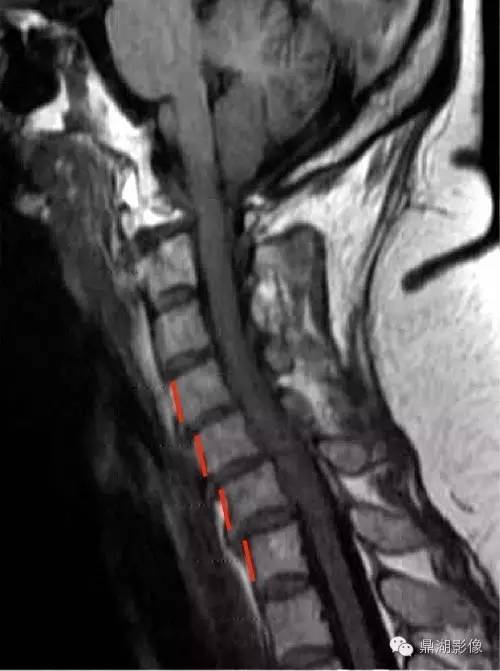 【病例】类风湿关节炎1例MRI诊断分析 【病例】类风湿关节炎1例MRI诊断分析