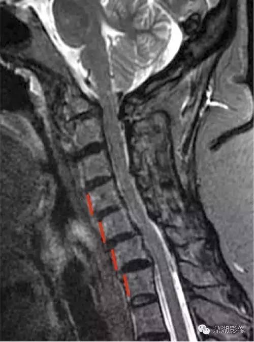 【病例】类风湿关节炎1例MRI诊断分析 【病例】类风湿关节炎1例MRI诊断分析