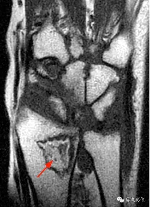 【病例】类风湿关节炎1例MRI诊断分析 【病例】类风湿关节炎1例MRI诊断分析
