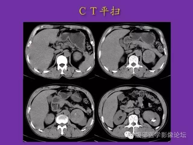 【病例】后肾腺瘤1例CT影像诊断与鉴别 【病例】后肾腺瘤1例CT影像诊断与鉴别