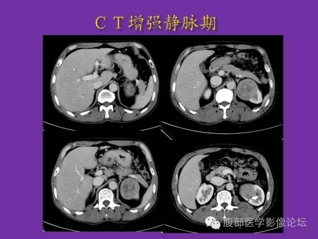【病例】后肾腺瘤1例CT影像诊断与鉴别 【病例】后肾腺瘤1例CT影像诊断与鉴别
