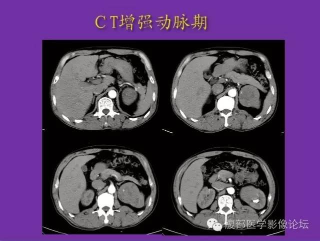 【病例】后肾腺瘤1例CT影像诊断与鉴别 【病例】后肾腺瘤1例CT影像诊断与鉴别