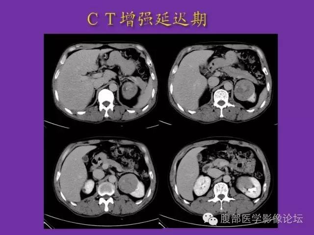 【病例】后肾腺瘤1例CT影像诊断与鉴别 【病例】后肾腺瘤1例CT影像诊断与鉴别