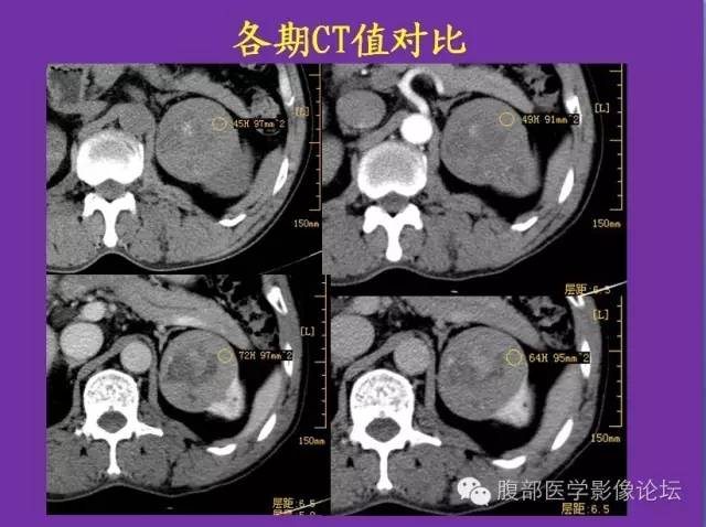 【病例】后肾腺瘤1例CT影像诊断与鉴别 【病例】后肾腺瘤1例CT影像诊断与鉴别