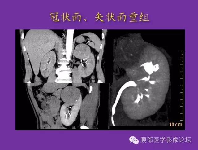 【病例】后肾腺瘤1例CT影像诊断与鉴别 【病例】后肾腺瘤1例CT影像诊断与鉴别