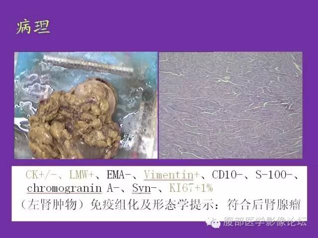 【病例】后肾腺瘤1例CT影像诊断与鉴别 【病例】后肾腺瘤1例CT影像诊断与鉴别