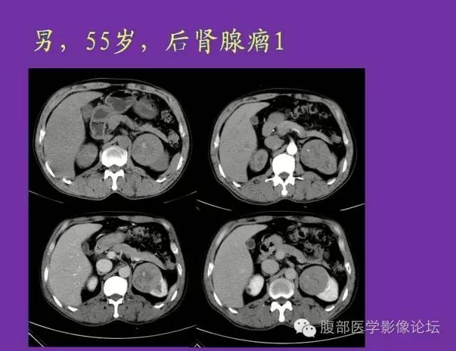 【病例】后肾腺瘤1例CT影像诊断与鉴别 【病例】后肾腺瘤1例CT影像诊断与鉴别
