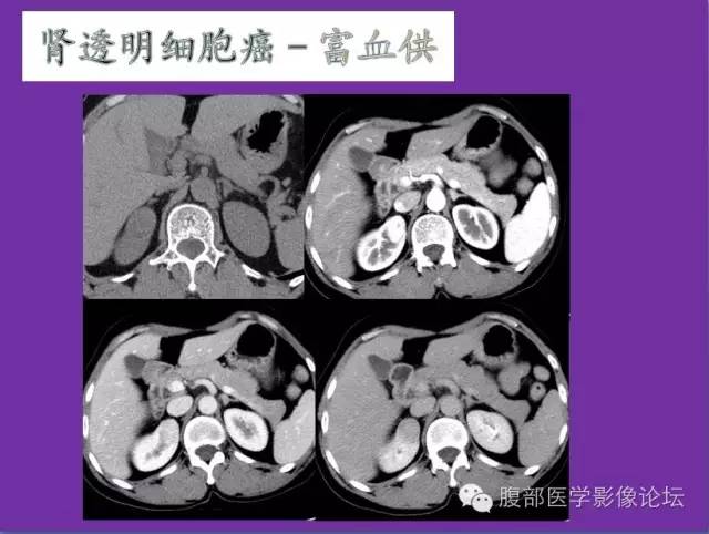 【病例】后肾腺瘤1例CT影像诊断与鉴别 【病例】后肾腺瘤1例CT影像诊断与鉴别
