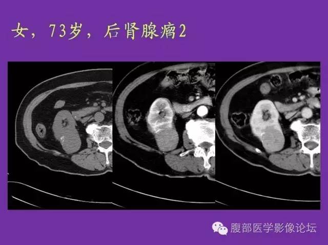 【病例】后肾腺瘤1例CT影像诊断与鉴别 【病例】后肾腺瘤1例CT影像诊断与鉴别