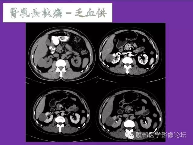 【病例】后肾腺瘤1例CT影像诊断与鉴别 【病例】后肾腺瘤1例CT影像诊断与鉴别
