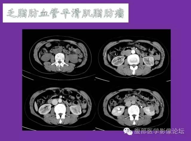 【病例】后肾腺瘤1例CT影像诊断与鉴别 【病例】后肾腺瘤1例CT影像诊断与鉴别