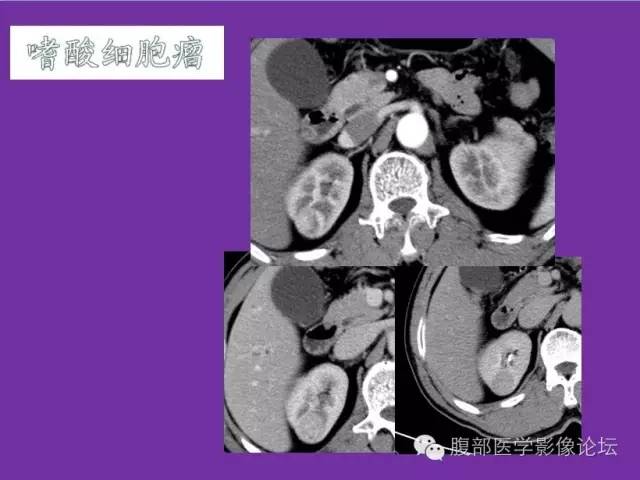 【病例】后肾腺瘤1例CT影像诊断与鉴别 【病例】后肾腺瘤1例CT影像诊断与鉴别