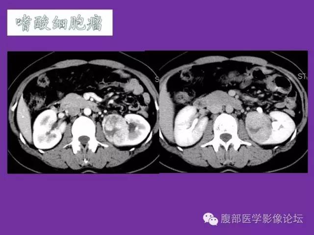 【病例】后肾腺瘤1例CT影像诊断与鉴别 【病例】后肾腺瘤1例CT影像诊断与鉴别