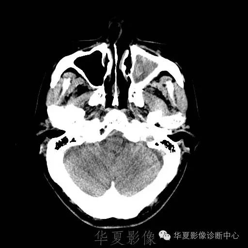 硬膜外还是硬膜下出血，你分清了吗？