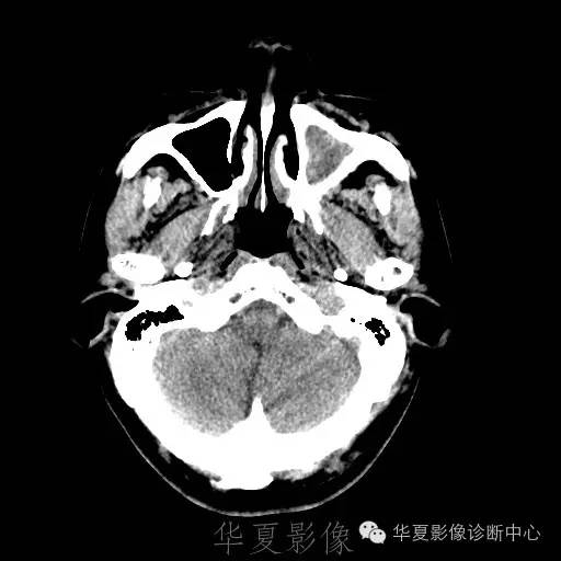 硬膜外还是硬膜下出血，你分清了吗？
