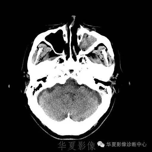 硬膜外还是硬膜下出血，你分清了吗？