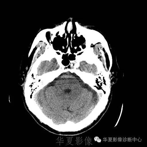 硬膜外还是硬膜下出血，你分清了吗？