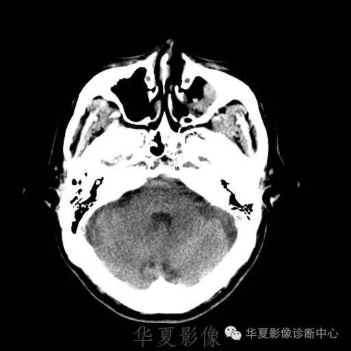 硬膜外还是硬膜下出血，你分清了吗？