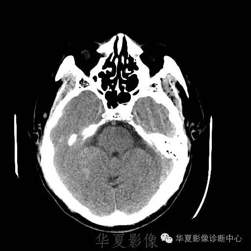 硬膜外还是硬膜下出血，你分清了吗？