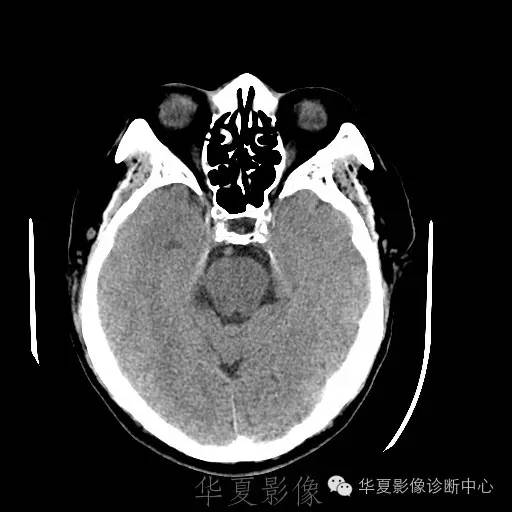 硬膜外还是硬膜下出血，你分清了吗？