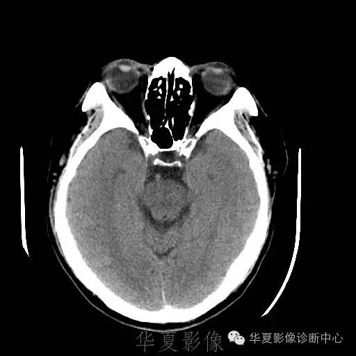 硬膜外还是硬膜下出血，你分清了吗？