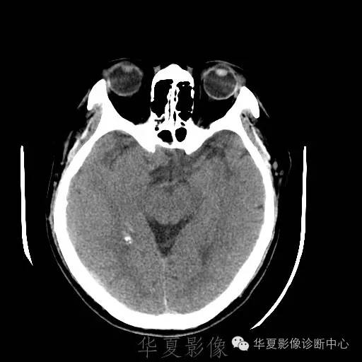 硬膜外还是硬膜下出血，你分清了吗？
