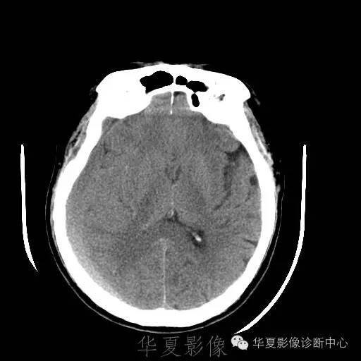 硬膜外还是硬膜下出血，你分清了吗？