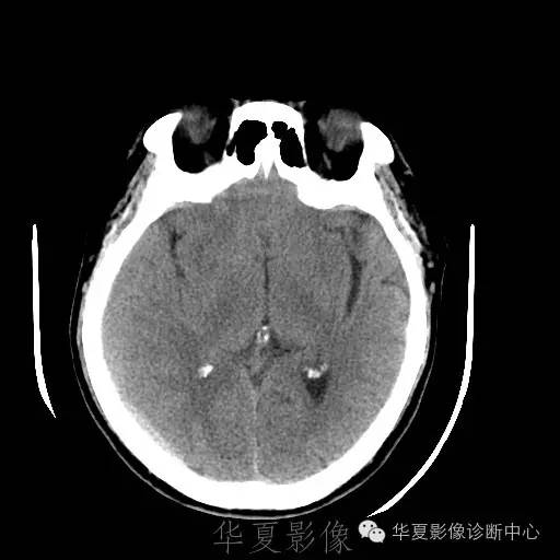 硬膜外还是硬膜下出血，你分清了吗？
