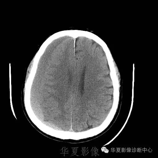 硬膜外还是硬膜下出血，你分清了吗？