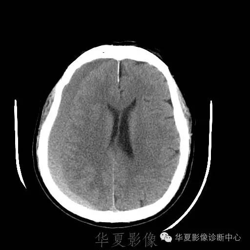 硬膜外还是硬膜下出血，你分清了吗？