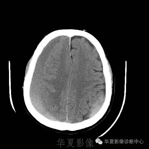 硬膜外还是硬膜下出血，你分清了吗？
