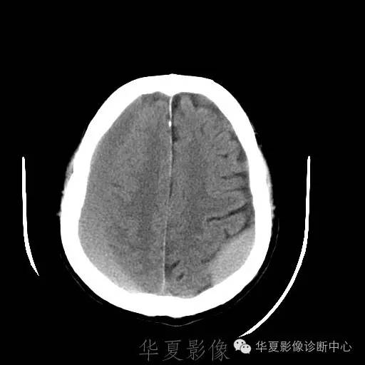 硬膜外还是硬膜下出血，你分清了吗？