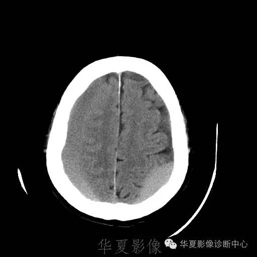 硬膜外还是硬膜下出血，你分清了吗？