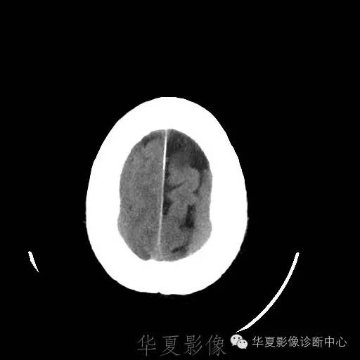 硬膜外还是硬膜下出血，你分清了吗？