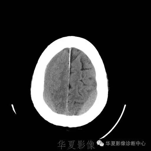 硬膜外还是硬膜下出血，你分清了吗？