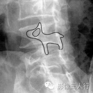 "狗颈征"，这个征象提示啥？