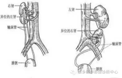肾脏异位 肾脏异位