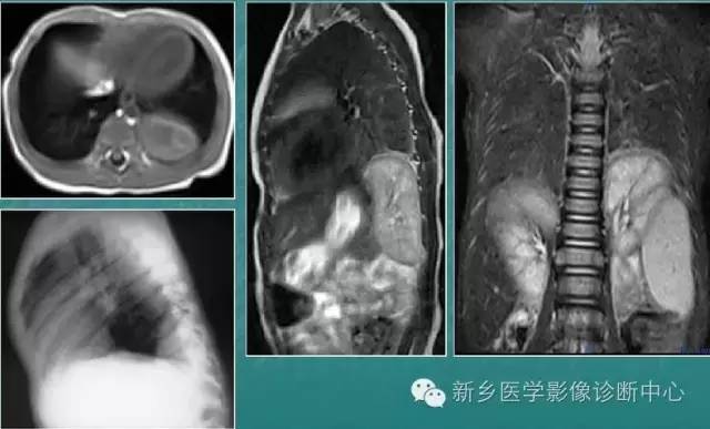 肾脏异位 肾脏异位