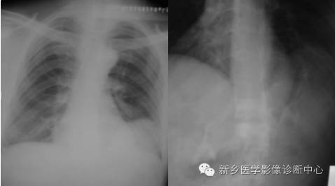 肾脏异位 肾脏异位